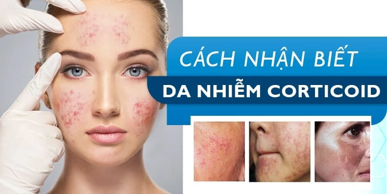 cach-nhan-biet-da-nhiem-doc-corticoid